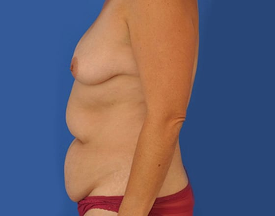 meridian-liposuction-before