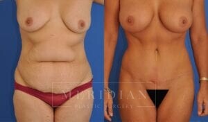 tjelmeland-meridian-austin-abdominoplasty-patient-1-1