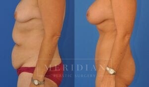 tjelmeland-meridian-austin-abdominoplasty-patient-1-2