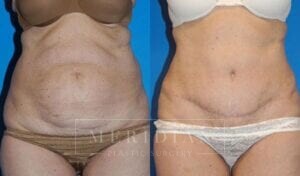 tjelmeland-meridian-austin-abdominoplasty-patient-10-1