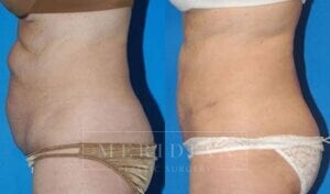 tjelmeland-meridian-austin-abdominoplasty-patient-10-2