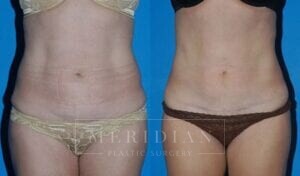 tjelmeland-meridian-austin-abdominoplasty-patient-11-1