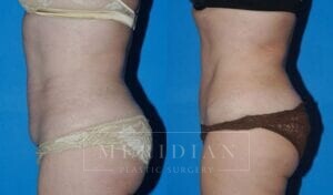 tjelmeland-meridian-austin-abdominoplasty-patient-11-2