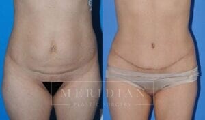 tjelmeland-meridian-austin-abdominoplasty-patient-13-1