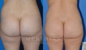 tjelmeland-meridian-austin-abdominoplasty-patient-13-2