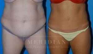 tjelmeland-meridian-austin-abdominoplasty-patient-14-1