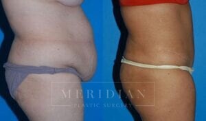 tjelmeland-meridian-austin-abdominoplasty-patient-14-2