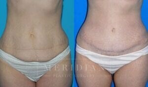 tjelmeland-meridian-austin-abdominoplasty-patient-17-1