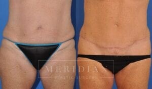 tjelmeland-meridian-austin-abdominoplasty-patient-18-1