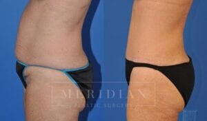 tjelmeland-meridian-austin-abdominoplasty-patient-18-2