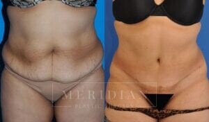 tjelmeland-meridian-austin-abdominoplasty-patient-19-1