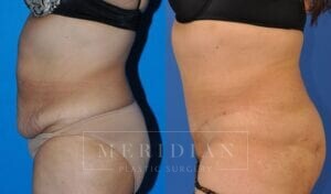 tjelmeland-meridian-austin-abdominoplasty-patient-19-2