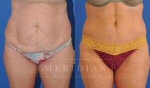 tjelmeland-meridian-austin-abdominoplasty-patient-2-1