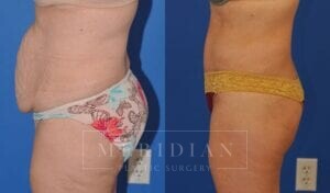 tjelmeland-meridian-austin-abdominoplasty-patient-2-2