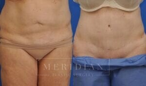 tjelmeland-meridian-austin-abdominoplasty-patient-20-1