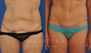 tjelmeland-meridian-austin-abdominoplasty-patient-21-1