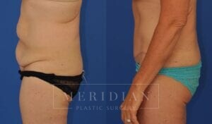 tjelmeland-meridian-austin-abdominoplasty-patient-21-2