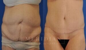 tjelmeland-meridian-austin-abdominoplasty-patient-22-1