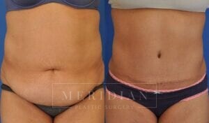 tjelmeland-meridian-austin-abdominoplasty-patient-23-1