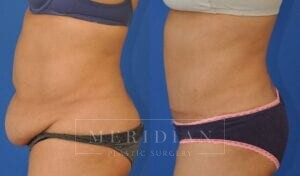 tjelmeland-meridian-austin-abdominoplasty-patient-23-2