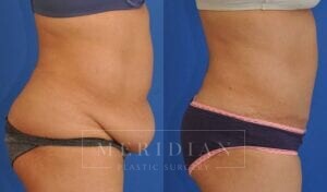 tjelmeland-meridian-austin-abdominoplasty-patient-23-3