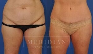 tjelmeland-meridian-austin-abdominoplasty-patient-24-1