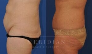 tjelmeland-meridian-austin-abdominoplasty-patient-24-3