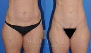 tjelmeland-meridian-austin-abdominoplasty-patient-3-1