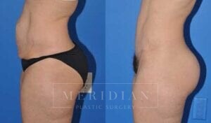 tjelmeland-meridian-austin-abdominoplasty-patient-3-2