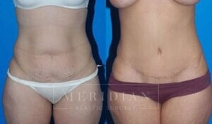 tjelmeland-meridian-austin-abdominoplasty-patient-5-1