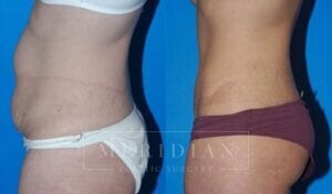 tjelmeland-meridian-austin-abdominoplasty-patient-5-2