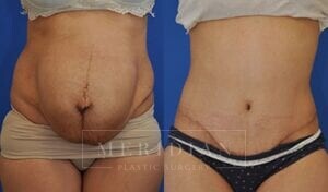 tjelmeland-meridian-austin-abdominoplasty-patient-6-1