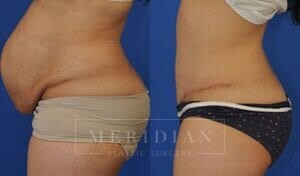 tjelmeland-meridian-austin-abdominoplasty-patient-6-2