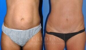 tjelmeland-meridian-austin-abdominoplasty-patient-7-1