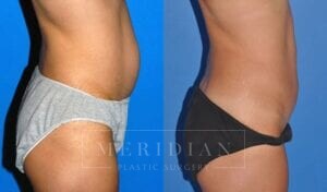 tjelmeland-meridian-austin-abdominoplasty-patient-7-2