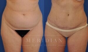 tjelmeland-meridian-austin-abdominoplasty-patient-9-1