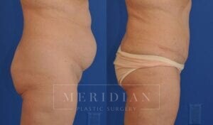 tjelmeland-meridian-austin-abdominoplasty-patient-9-2