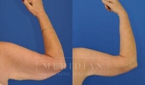 tjelmeland-meridian-austin-arm-lift-patient-4-2