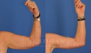 tjelmeland-meridian-austin-arm-lift-patient-5-1