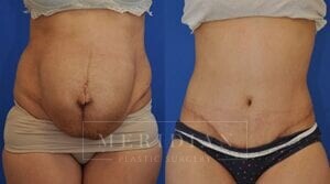 tjelmeland-meridian-austin-body-contouring-patient-1-1