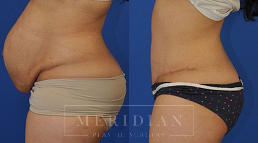 tjelmeland-meridian-austin-body-contouring-patient-1-2