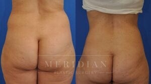 tjelmeland-meridian-austin-body-contouring-patient-1-3