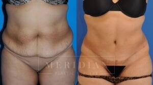 tjelmeland-meridian-austin-body-contouring-patient-12-1