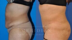 tjelmeland-meridian-austin-body-contouring-patient-12-2