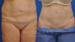 tjelmeland-meridian-austin-body-contouring-patient-13-1