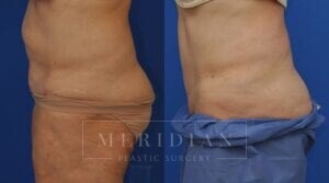 tjelmeland-meridian-austin-body-contouring-patient-13-2