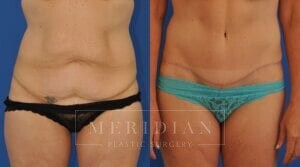 tjelmeland-meridian-austin-body-contouring-patient-14-1