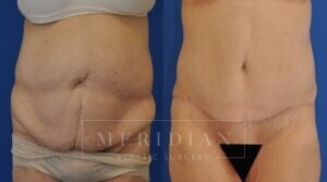 tjelmeland-meridian-austin-body-contouring-patient-15-1