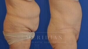 tjelmeland-meridian-austin-body-contouring-patient-15-2