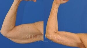 tjelmeland-meridian-austin-body-contouring-patient-16-1